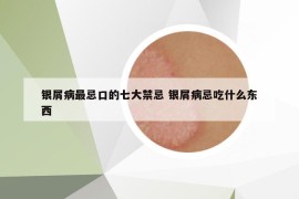 银屑病最忌口的七大禁忌 银屑病忌吃什么东西
