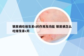 银屑病吃维生素c的作用及功能 银屑病怎么吃维生素c片
