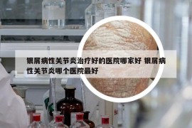 银屑病性关节炎治疗好的医院哪家好 银屑病性关节炎哪个医院最好