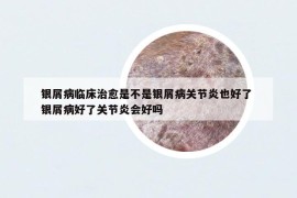 银屑病临床治愈是不是银屑病关节炎也好了 银屑病好了关节炎会好吗