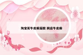淘宝买牛皮癣凝胶 网店牛皮癣