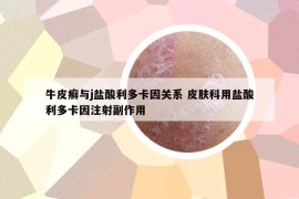 牛皮癣与j盐酸利多卡因关系 皮肤科用盐酸利多卡因注射副作用