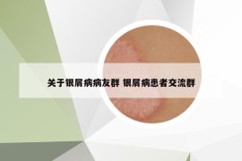 关于银屑病病友群 银屑病患者交流群