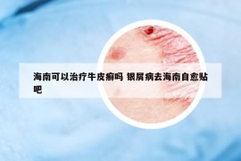 海南可以治疗牛皮癣吗 银屑病去海南自愈贴吧