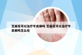 芝麻花可以治疗牛皮癣吗 芝麻花可以治疗牛皮癣吗怎么吃