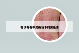 有没有看牛皮癣留下的黑色素