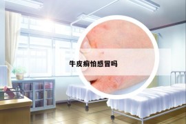 牛皮癣怕感冒吗