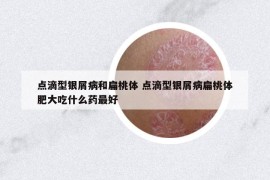 点滴型银屑病和扁桃体 点滴型银屑病扁桃体肥大吃什么药最好