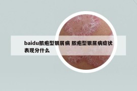 baidu脓疱型银屑病 脓疱型银屑病症状表现分什么