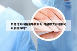 白醋泡大蒜能治牛皮癣吗 白醋跟大蒜泡脚可以去脚气吗?
