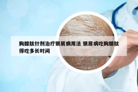 胸腺肽针剂治疗银屑病用法 银屑病吃胸腺肽得吃多长时间