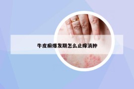 牛皮癣爆发期怎么止痒消肿