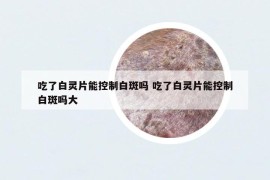 吃了白灵片能控制白斑吗 吃了白灵片能控制白斑吗大