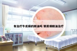 有治疗牛皮癣的精油吗 银屑病精油治疗