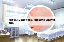 银屑病不可以吃红肉吗 银屑病患者可以吃红薯吗