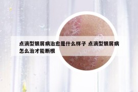 点滴型银屑病治愈是什么样子 点滴型银屑病怎么治才能断根