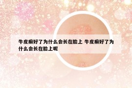 牛皮癣好了为什么会长在脸上 牛皮癣好了为什么会长在脸上呢
