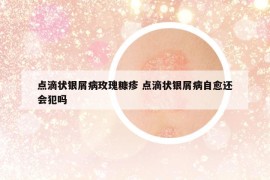 点滴状银屑病玫瑰糠疹 点滴状银屑病自愈还会犯吗