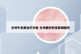 沧州牛皮癣治疗价格 沧州最好的皮肤病医院