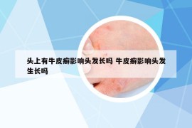 头上有牛皮癣影响头发长吗 牛皮癣影响头发生长吗