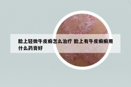 脸上轻微牛皮癣怎么治疗 脸上有牛皮癣癣用什么药膏好