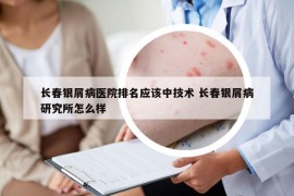 长春银屑病医院排名应该中技术 长春银屑病研究所怎么样