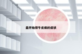 最开始得牛皮癣的症状