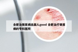 合肥治银屑病选国人good 合肥治疗银屑病的专科医院