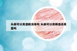 头癣可以用酒精消毒吗 头癣可以用碘酒杀真菌吗