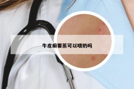 牛皮癣要蒸可以喂奶吗