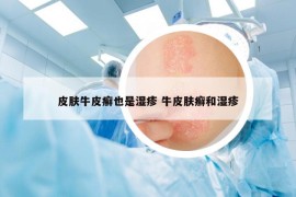 皮肤牛皮癣也是湿疹 牛皮肤癣和湿疹
