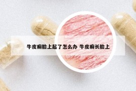 牛皮癣脸上起了怎么办 牛皮癣长脸上