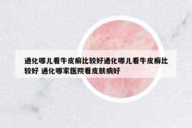 通化哪儿看牛皮癣比较好通化哪儿看牛皮癣比较好 通化哪家医院看皮肤病好