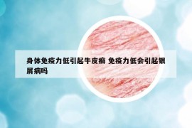 身体免疫力低引起牛皮癣 免疫力低会引起银屑病吗