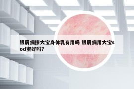 银屑病擦大宝身体乳有用吗 银屑病用大宝sod蜜好吗?