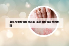 臭氧水治疗银屑病最好 臭氧治疗银屑病的机理