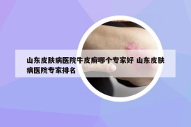 山东皮肤病医院牛皮癣哪个专家好 山东皮肤病医院专家排名