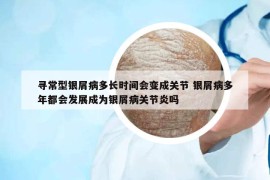寻常型银屑病多长时间会变成关节 银屑病多年都会发展成为银屑病关节炎吗
