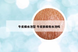 牛皮癣水泡型 牛皮肤癣有水泡吗
