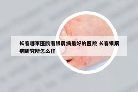长春哪家医院看银屑病最好的医院 长春银屑病研究所怎么样
