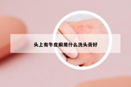 头上有牛皮癣用什么洗头膏好