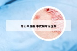 眉山牛皮癣 牛皮癣专治医院