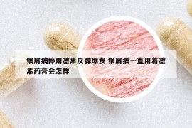银屑病停用激素反弹爆发 银屑病一直用着激素药膏会怎样
