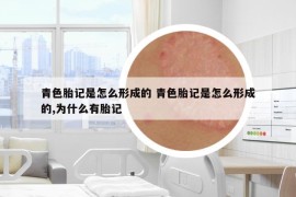 青色胎记是怎么形成的 青色胎记是怎么形成的,为什么有胎记