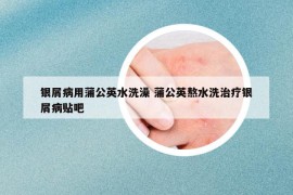 银屑病用蒲公英水洗澡 蒲公英熬水洗治疗银屑病贴吧