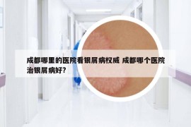 成都哪里的医院看银屑病权威 成都哪个医院治银屑病好?