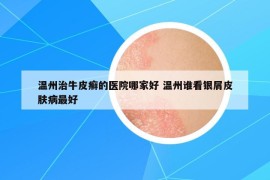 温州治牛皮癣的医院哪家好 温州谁看银屑皮肤病最好
