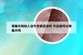 用偏方和给人治牛皮癣违法吗 牛皮癣可以用偏方吗