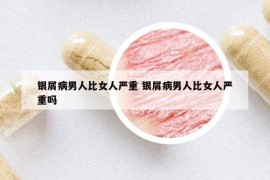 银屑病男人比女人严重 银屑病男人比女人严重吗
