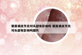 银屑病关节炎对头部有影响吗 银屑病关节炎对头部有影响吗图片
